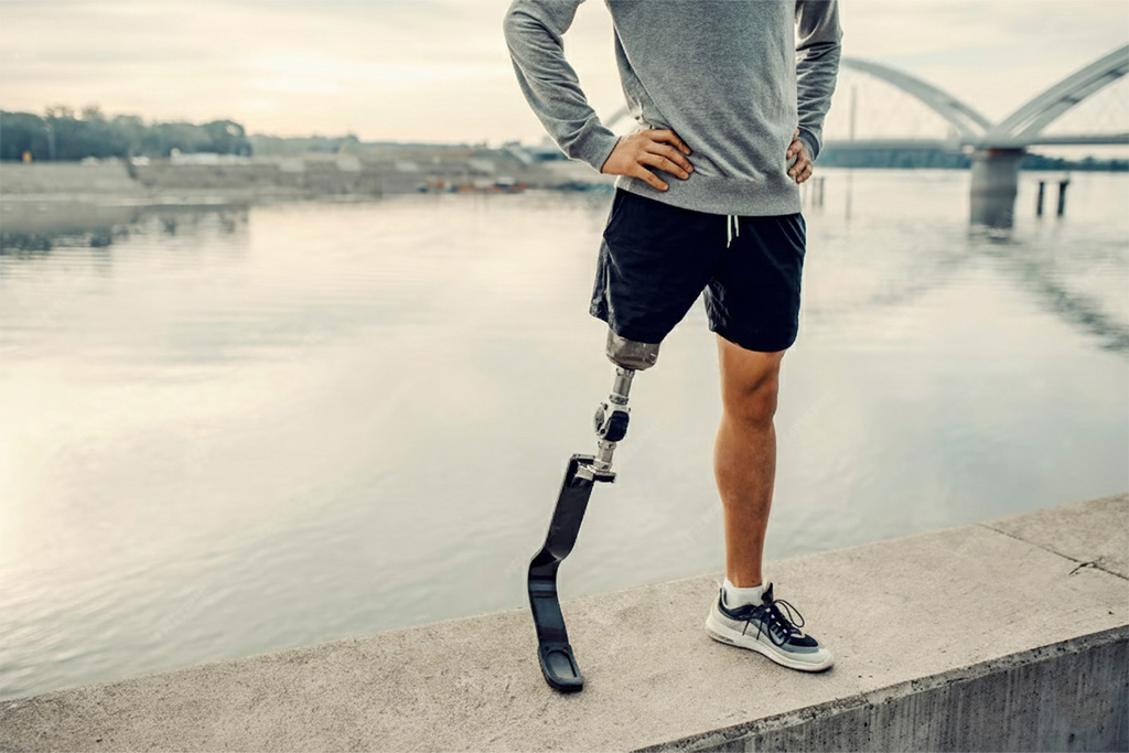 Trans-Femoral Prosthesis (Above Knee)-details